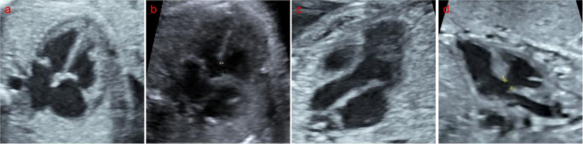 Application-of-artificial-intelligence-in-vsd-prenatal-diagnosis-from-fetal-heart-ultrasound-images