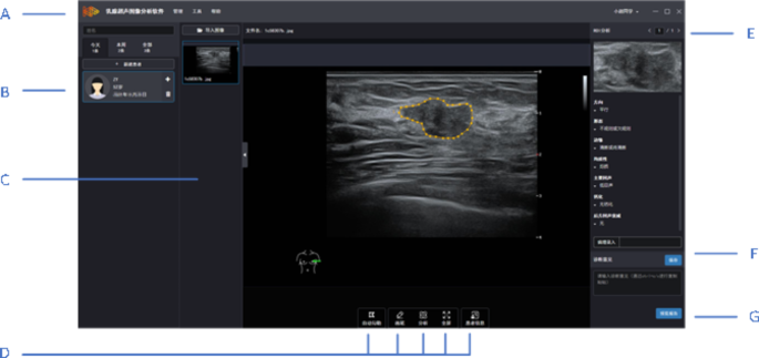 Accuracy-of-breast-ultrasound-image-analysis-software-in-feature-analysis-–-nature