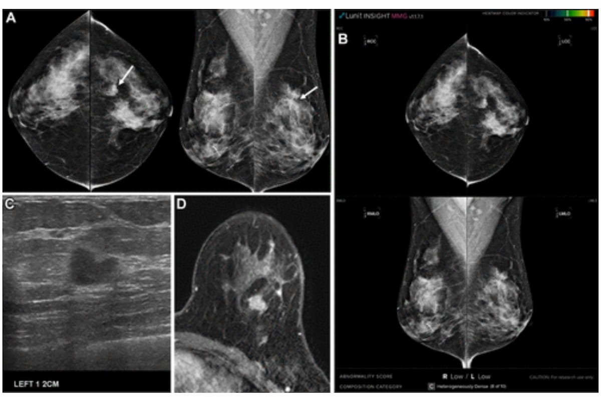 New-study-examines-key-factors-with-false-negatives-on-ai-mammography-analysis