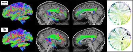 Tractography-from-t1-weighted-mri:-empirically-exploring-the-clinical-viability-of-streamline-…