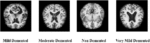 A-novel-interpreted-deep-network-for-alzheimer’s-disease-prediction-based-on-inverted-self-…