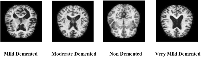 A-novel-interpreted-deep-network-for-alzheimer’s-disease-prediction-based-on-inverted-self-…
