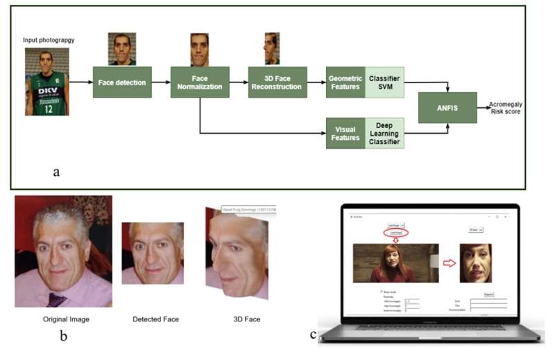 Precision increases in a project led by Germans Trias using AI to detect early facial changes in patients with acromegaly