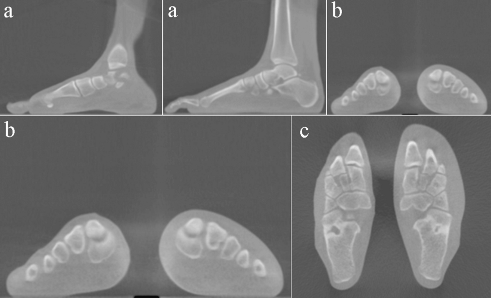 deep-learning-enhances-weightbearing-ct-detection-of-lisfranc-instability:-a-fixus-ai-ankle-insight-3d-algorithm