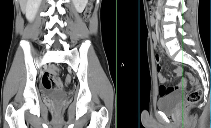 could-ai-aid-identification-of-vertebral-fractures?