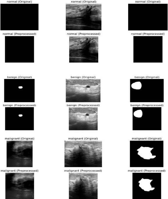 ensemble-based-high-performance-deep-learning-models-for-medical-image-retrieval-in-breast-cancer-detection-–-scientific-reports