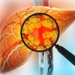 new-ai-blood-test-detects-silent-liver-disease-before-symptoms-appear