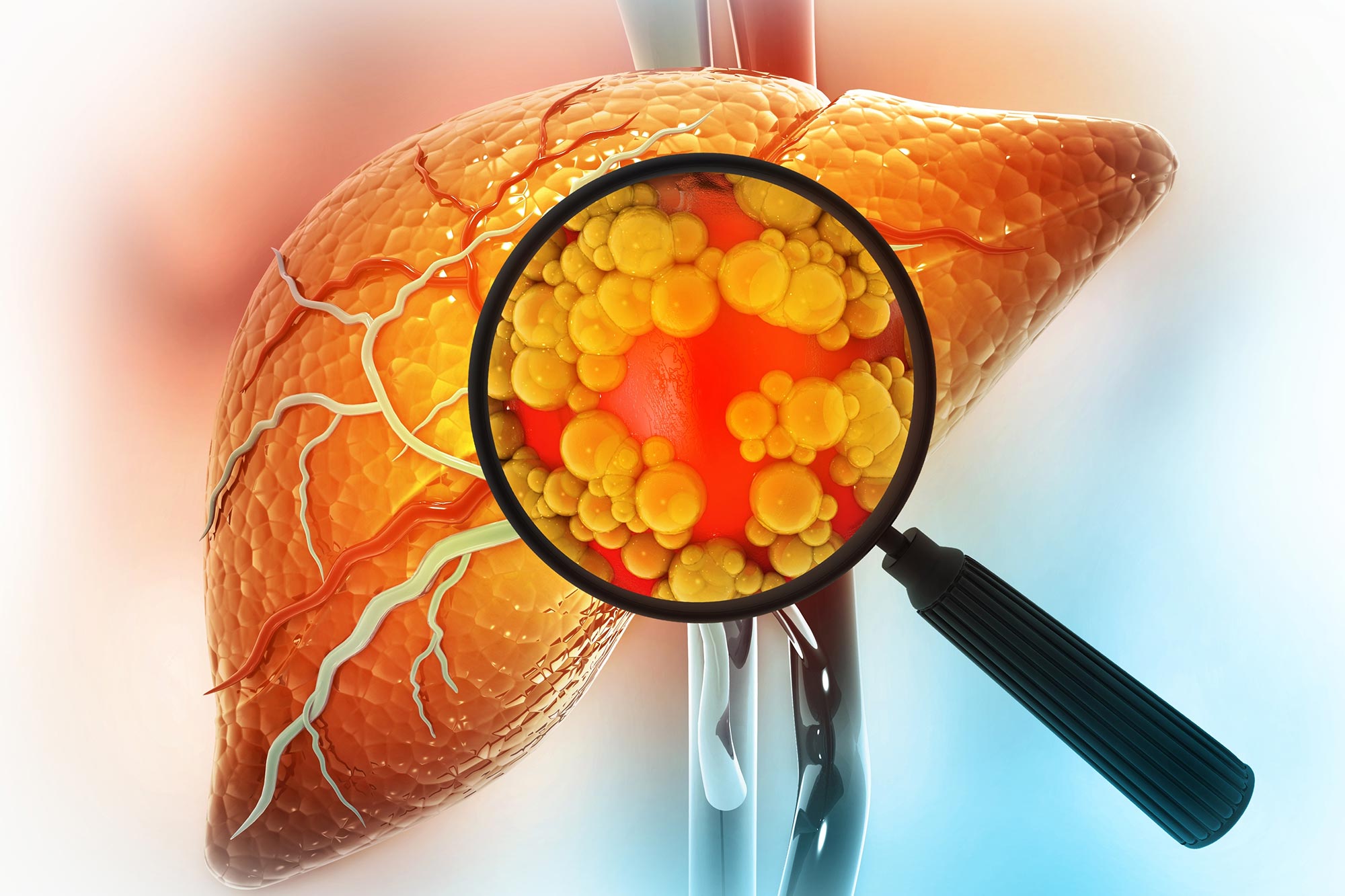 new-ai-blood-test-detects-silent-liver-disease-before-symptoms-appear