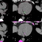 ai-tools-extract-hidden-health-insights-from-routine-chest-imaging