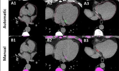 ai-tools-extract-hidden-health-insights-from-routine-chest-imaging