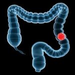 deep-learning-tme-analysis-improves-prognostic-discrimination-in-stage-iii-colon-cancer-|-cancernetwork