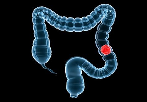 deep-learning-tme-analysis-improves-prognostic-discrimination-in-stage-iii-colon-cancer-|-cancernetwork