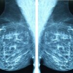 ai-image-based-risk-scores-enable-dynamic-breast-cancer-assessment