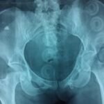 advancing-hip-fracture-prediction-with-ai