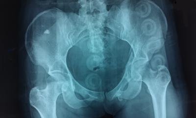 advancing-hip-fracture-prediction-with-ai