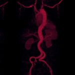 smart-solutions-are-transforming-aortic-dissection-diagnosis-and-repair