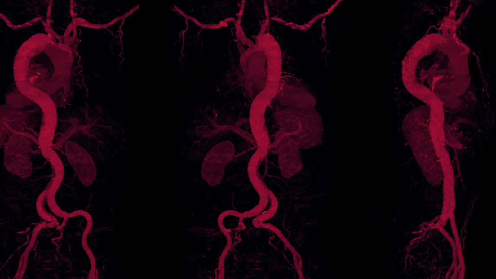 smart-solutions-are-transforming-aortic-dissection-diagnosis-and-repair