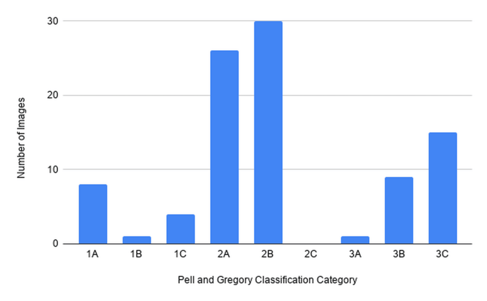 accuracy-of-general-use-multimodal-ai-platforms-for-pell-and-gregory-classification-of-impacted-mandibular-third-molars