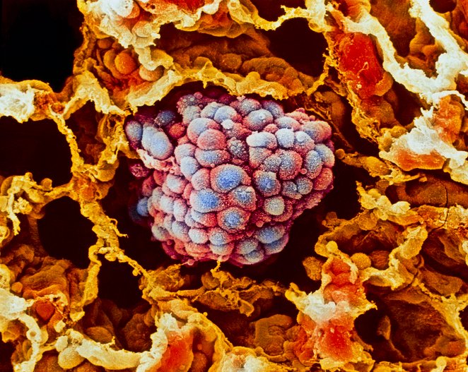 ai-tool-outperforms-pd-l1-for-predicting-lung-cancer-immunotherapy-outcomes