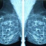 new-multimodal-ai-model-improves-breast-cancer-screening-accuracy