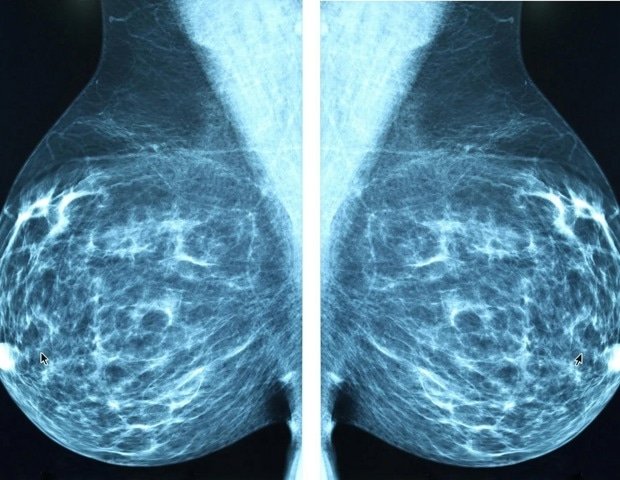 new-multimodal-ai-model-improves-breast-cancer-screening-accuracy
