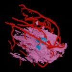 fda-clears-first-mri-derived-ai-software-for-assessing-breast-cancer-recurrence-risk-|-diagnostic-imaging