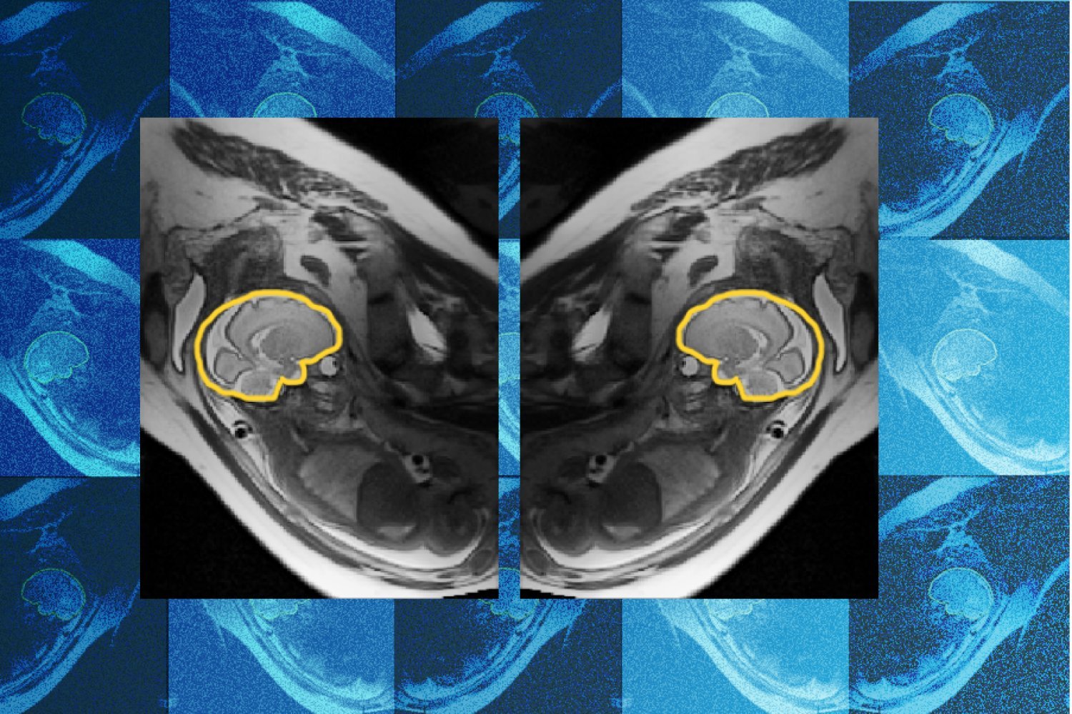 why-teaching-ai-about-symmetry-could-make-prenatal-diagnosis-more-reliable